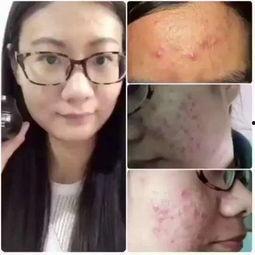 割粉刺视频,割粉刺视频教学揭秘